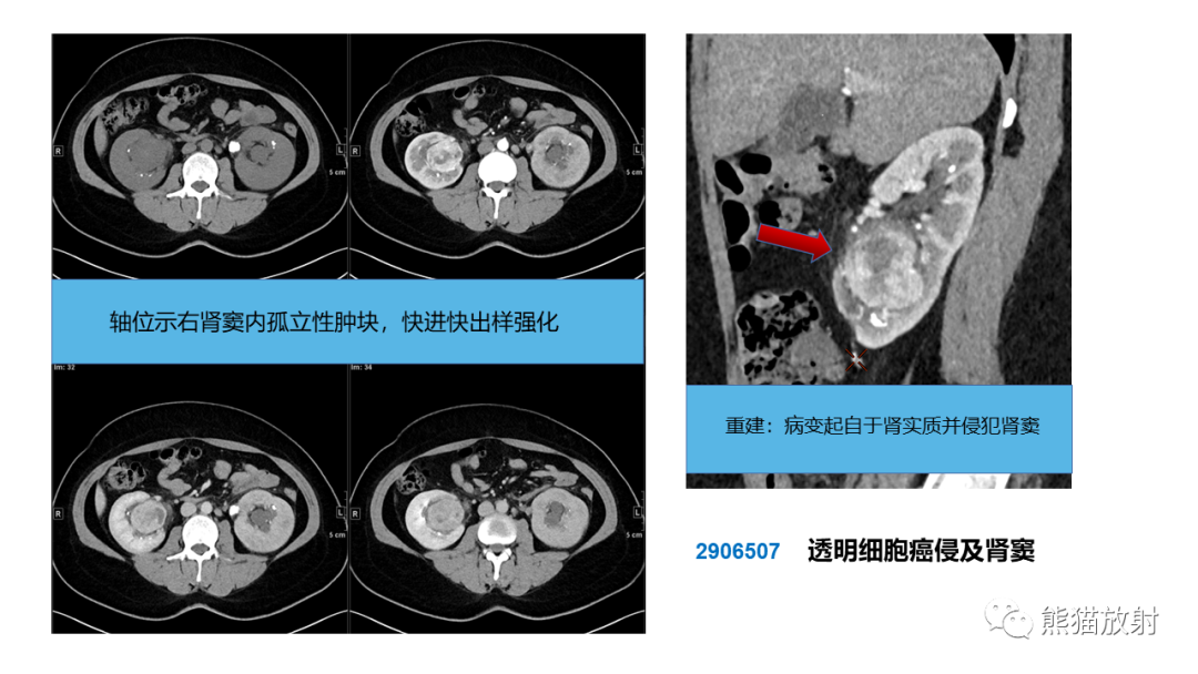 【PPT】肾窦病变影像诊断思路-46