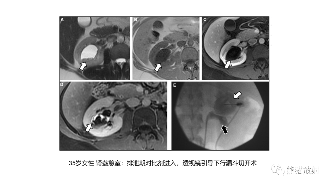 【PPT】肾窦病变影像诊断思路-29