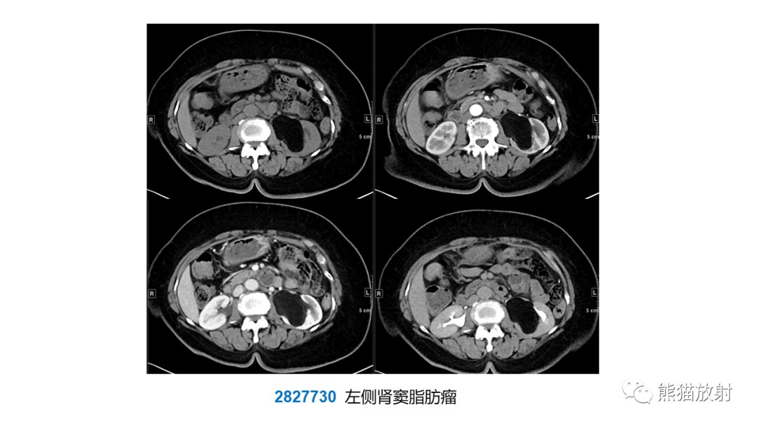 【PPT】肾窦病变影像诊断思路-22