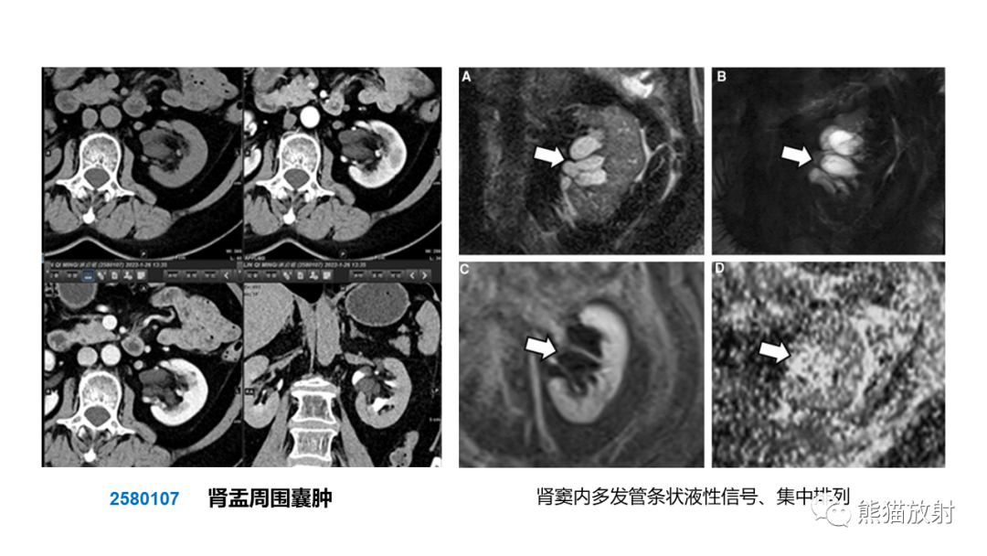 【PPT】肾窦病变影像诊断思路-26