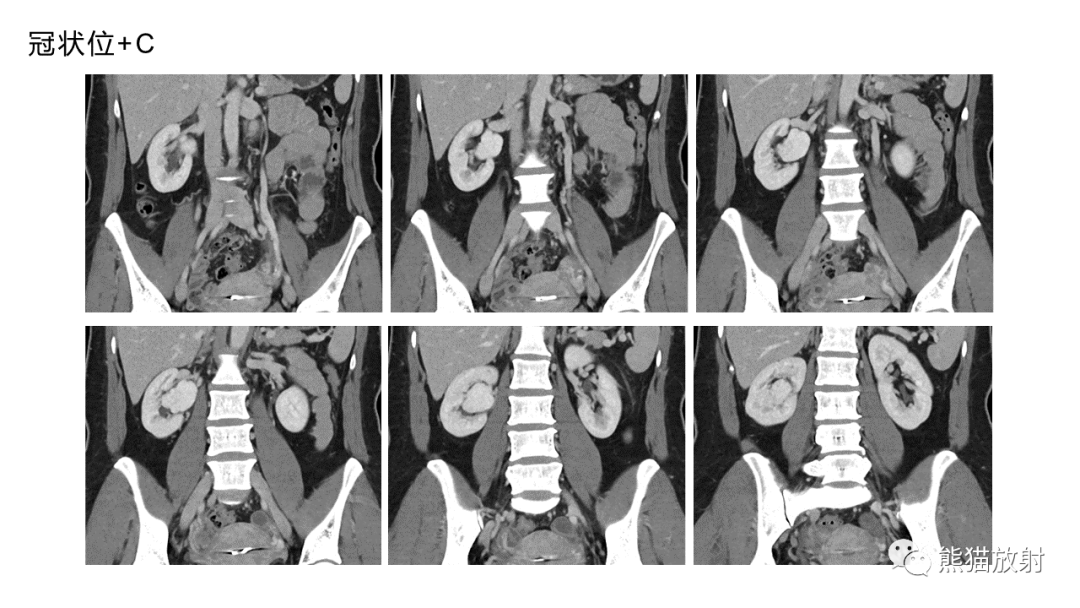 【PPT】肾窦病变影像诊断思路-12