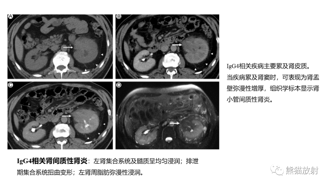【PPT】肾窦病变影像诊断思路-38