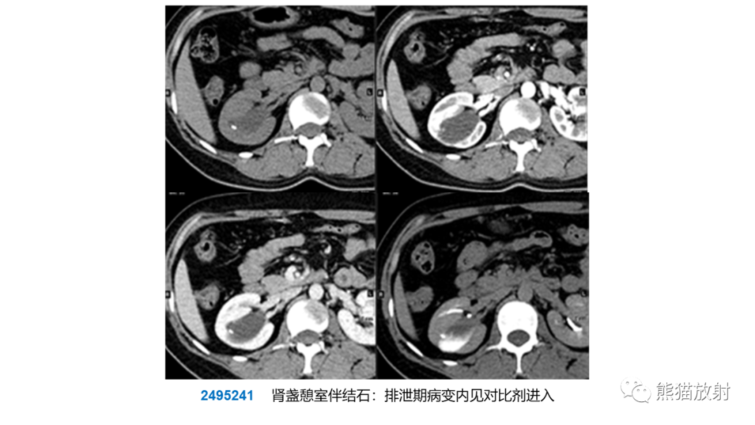 【PPT】肾窦病变影像诊断思路-28
