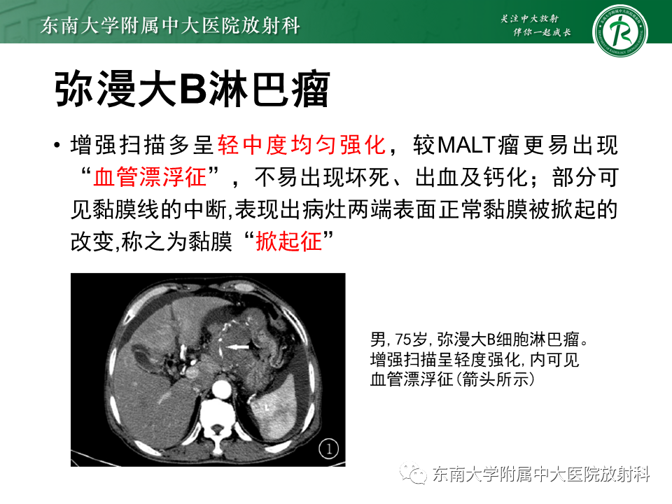 【PPT】胃黏膜相关淋巴组织(MALT)淋巴瘤-26