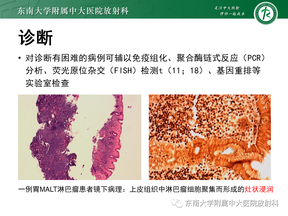 【PPT】胃黏膜相关淋巴组织(MALT)淋巴瘤-13