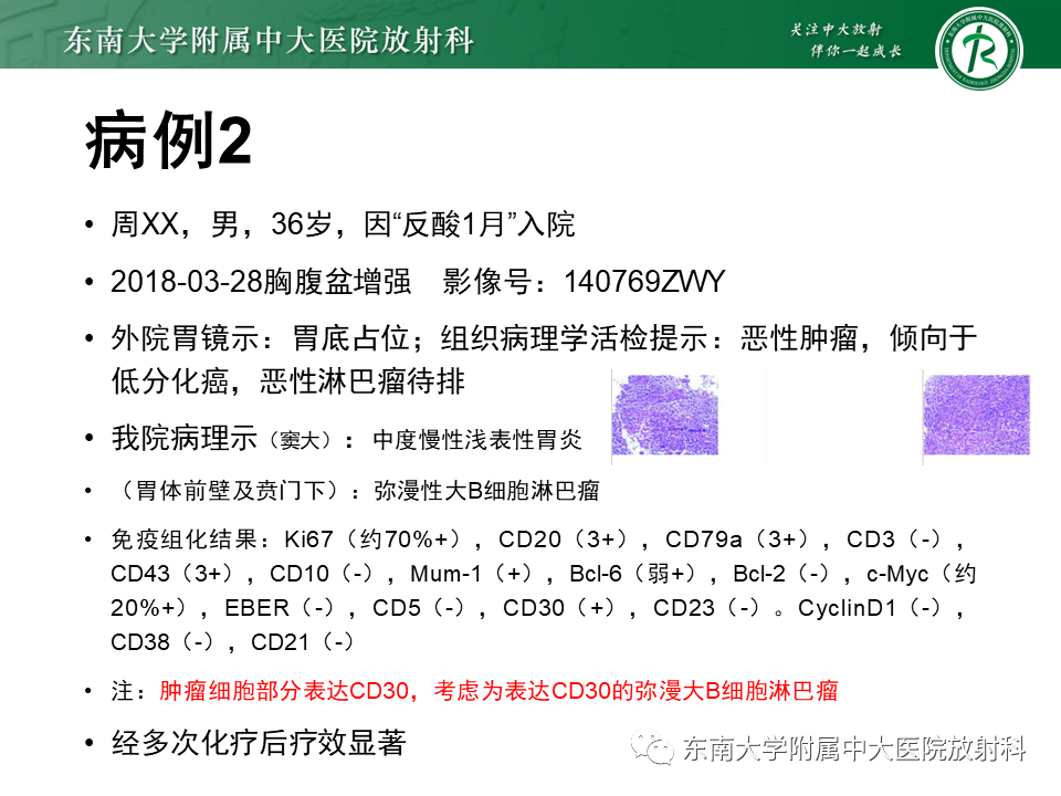 【PPT】胃黏膜相关淋巴组织(MALT)淋巴瘤-23