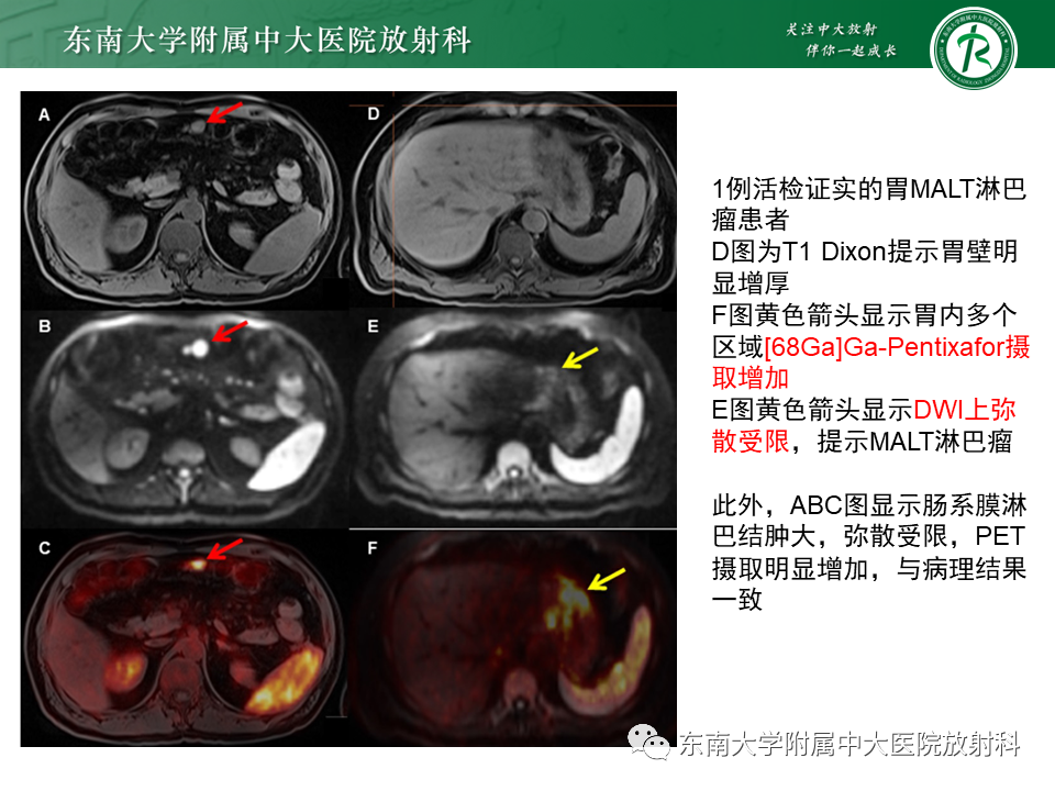 【PPT】胃黏膜相关淋巴组织(MALT)淋巴瘤-19