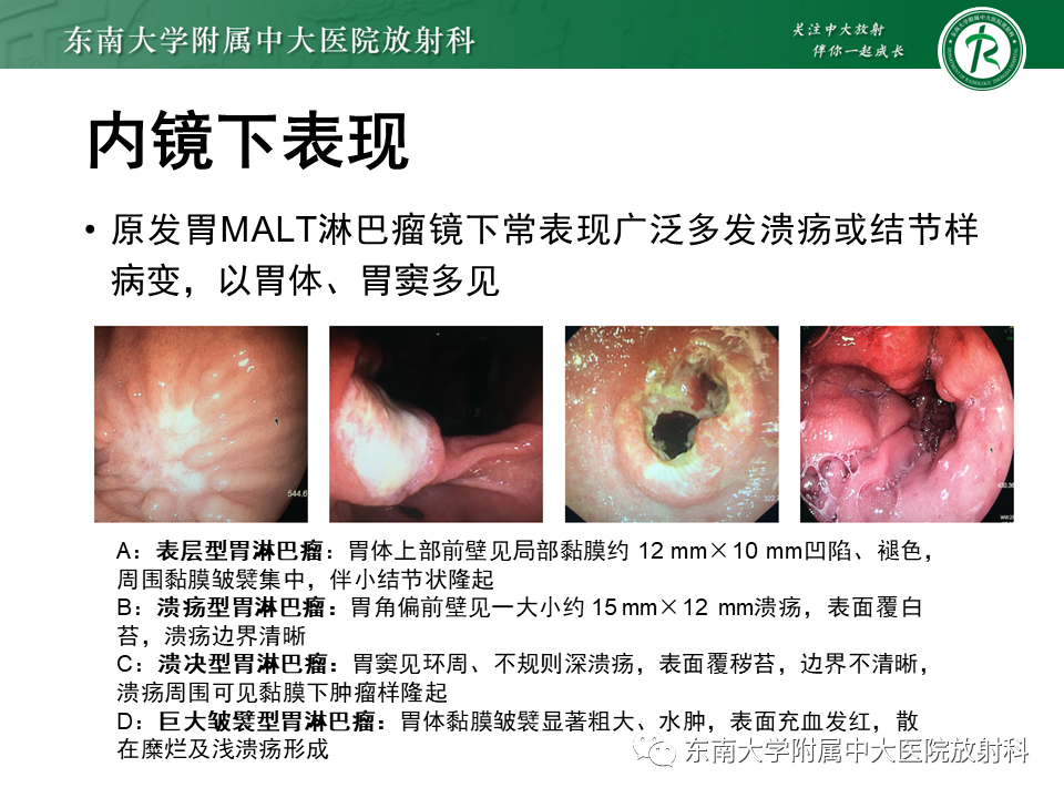 【PPT】胃黏膜相关淋巴组织(MALT)淋巴瘤-12