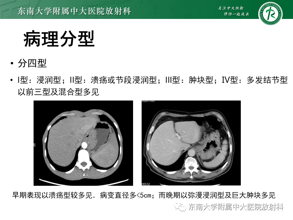 【PPT】胃黏膜相关淋巴组织(MALT)淋巴瘤-9