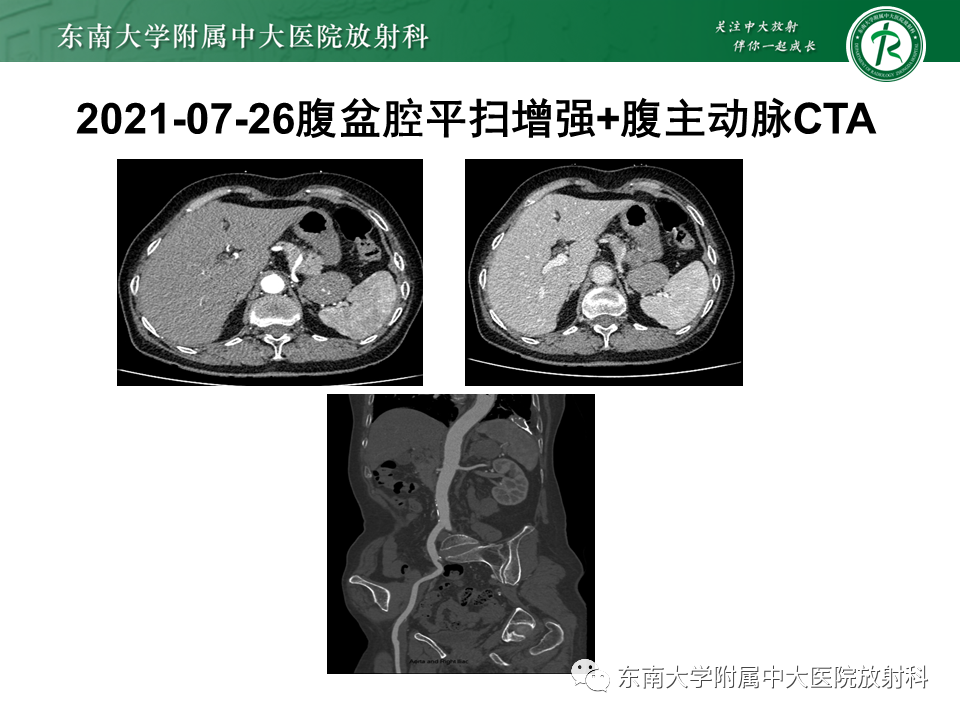 【PPT】胃黏膜相关淋巴组织(MALT)淋巴瘤-32