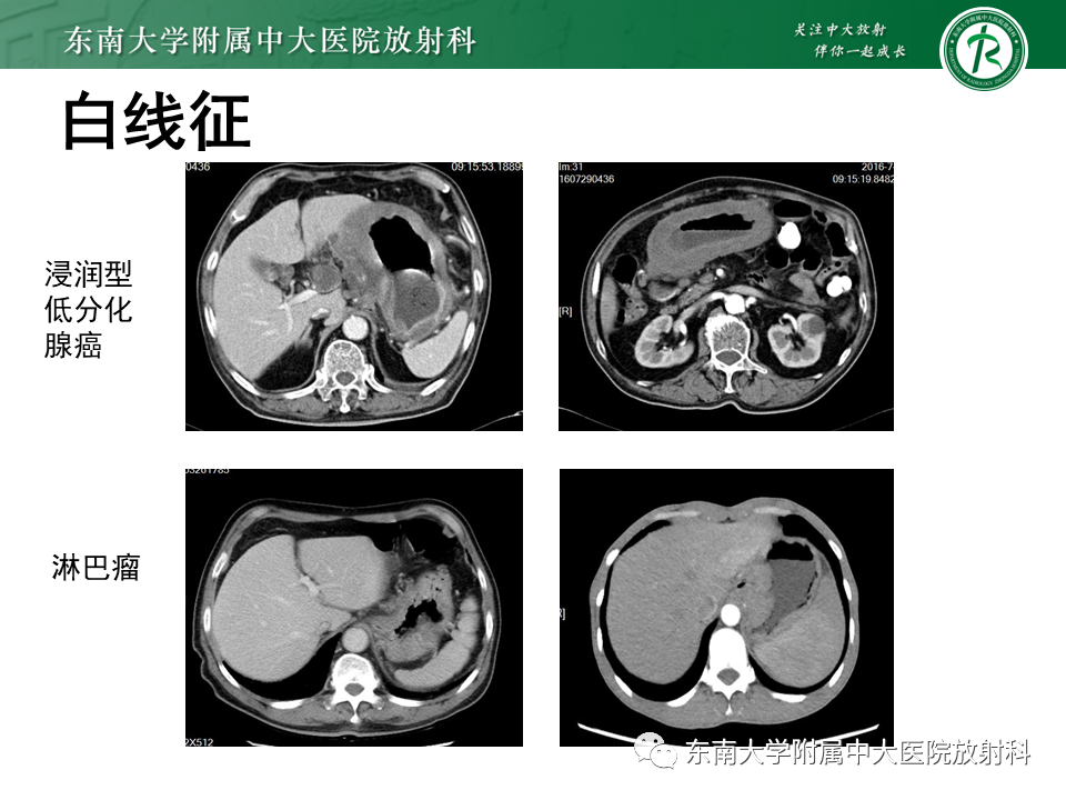 【PPT】胃黏膜相关淋巴组织(MALT)淋巴瘤-30