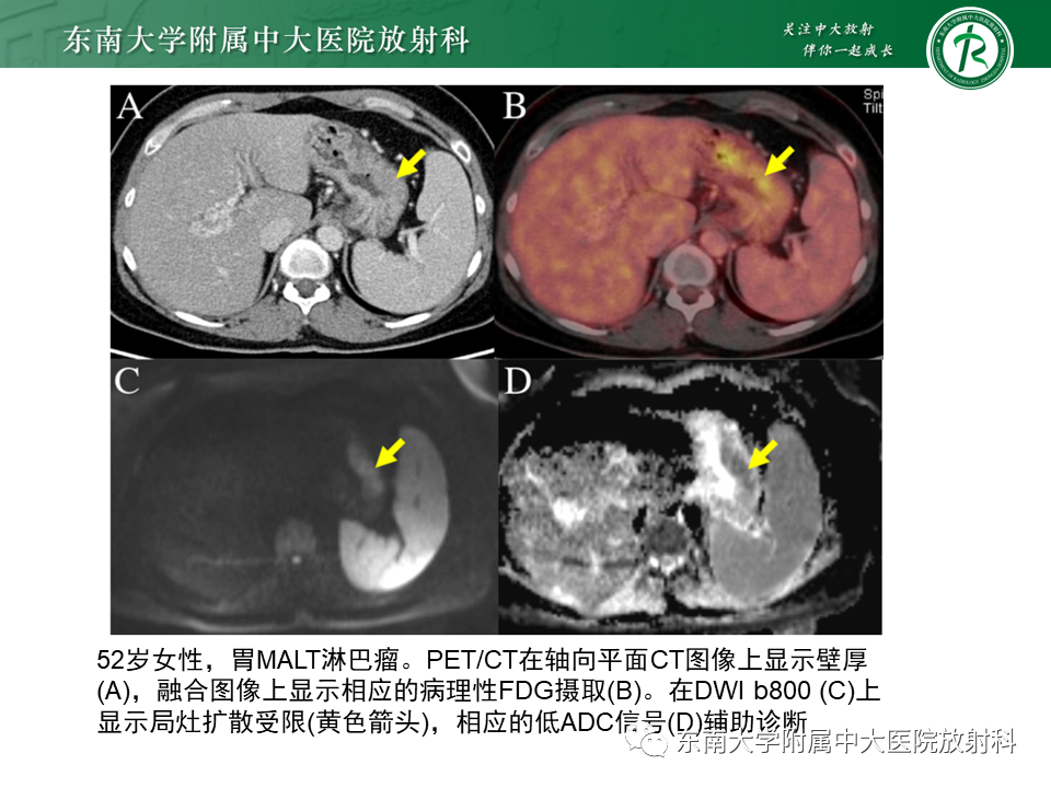 【PPT】胃黏膜相关淋巴组织(MALT)淋巴瘤-17