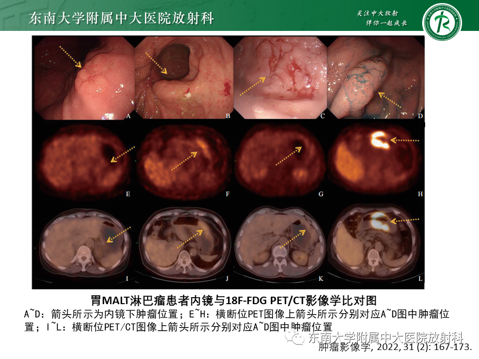 【PPT】胃黏膜相关淋巴组织(MALT)淋巴瘤-20