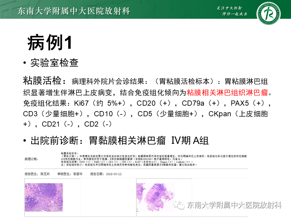 【PPT】胃黏膜相关淋巴组织(MALT)淋巴瘤-3