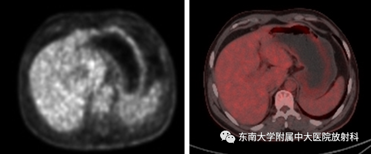 【PPT】胃黏膜相关淋巴组织(MALT)淋巴瘤-2