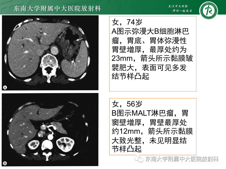 【PPT】胃黏膜相关淋巴组织(MALT)淋巴瘤-27