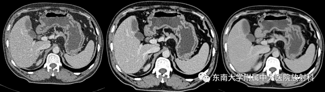 【PPT】胃黏膜相关淋巴组织(MALT)淋巴瘤-1