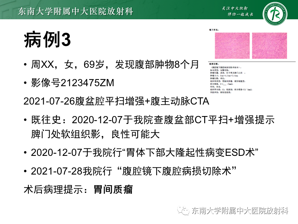 【PPT】胃黏膜相关淋巴组织(MALT)淋巴瘤-31