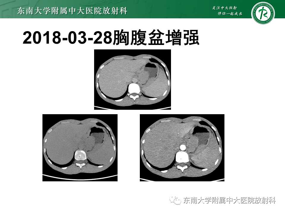 【PPT】胃黏膜相关淋巴组织(MALT)淋巴瘤-24