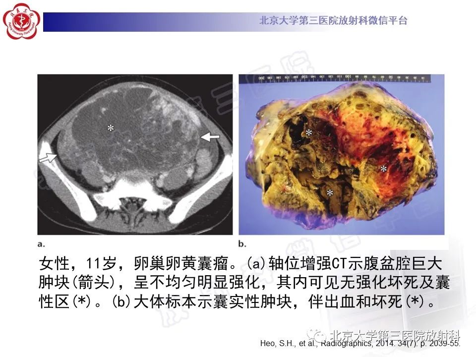 【PPT】卵巢卵黄囊瘤/内胚窦瘤-16