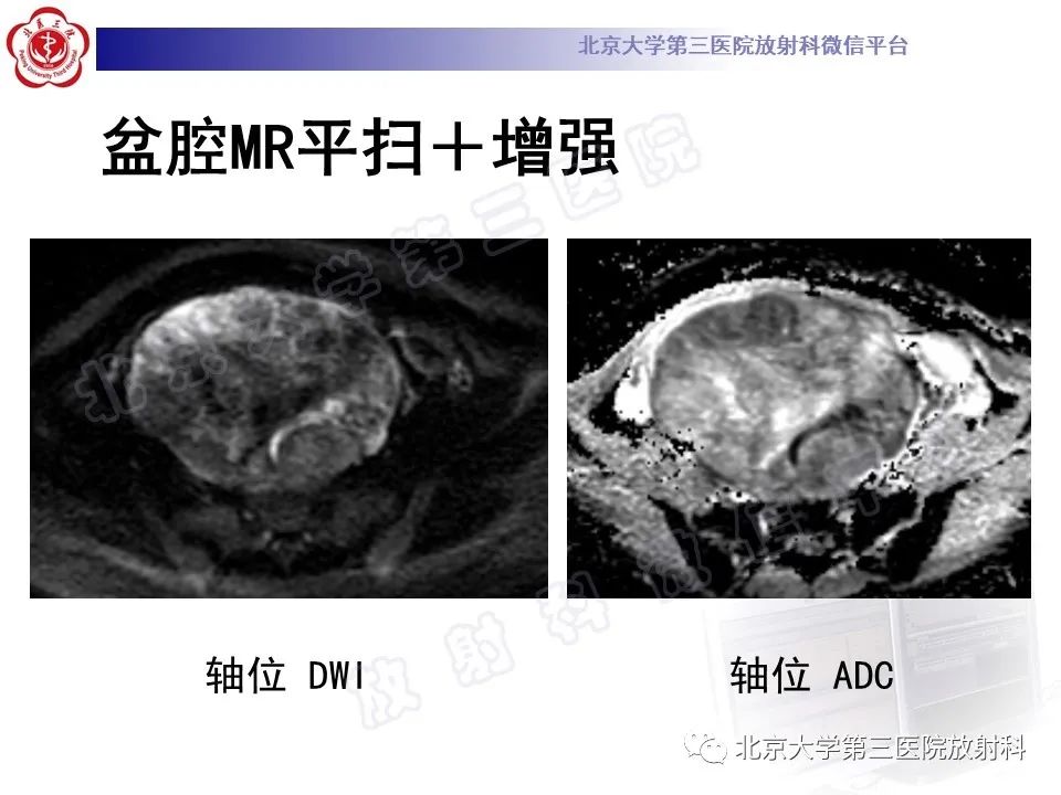 【PPT】卵巢卵黄囊瘤/内胚窦瘤-5