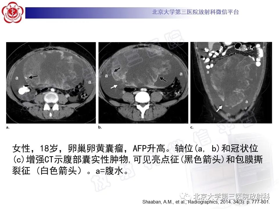 【PPT】卵巢卵黄囊瘤/内胚窦瘤-17