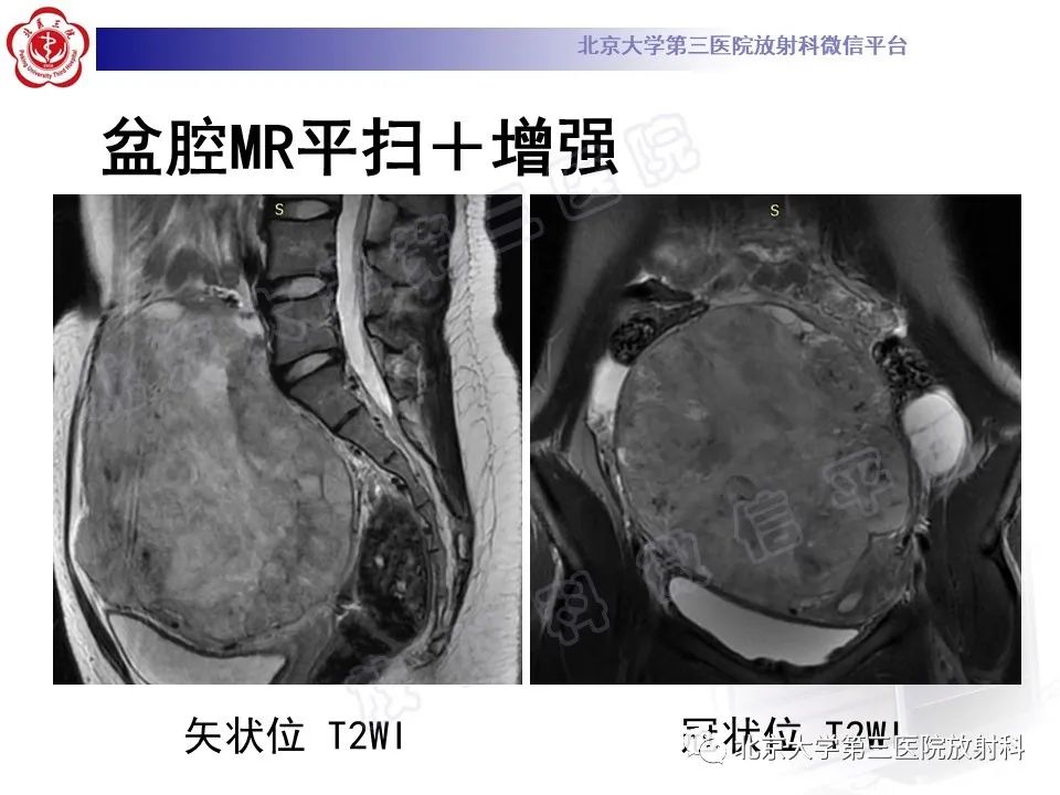 【PPT】卵巢卵黄囊瘤/内胚窦瘤-4