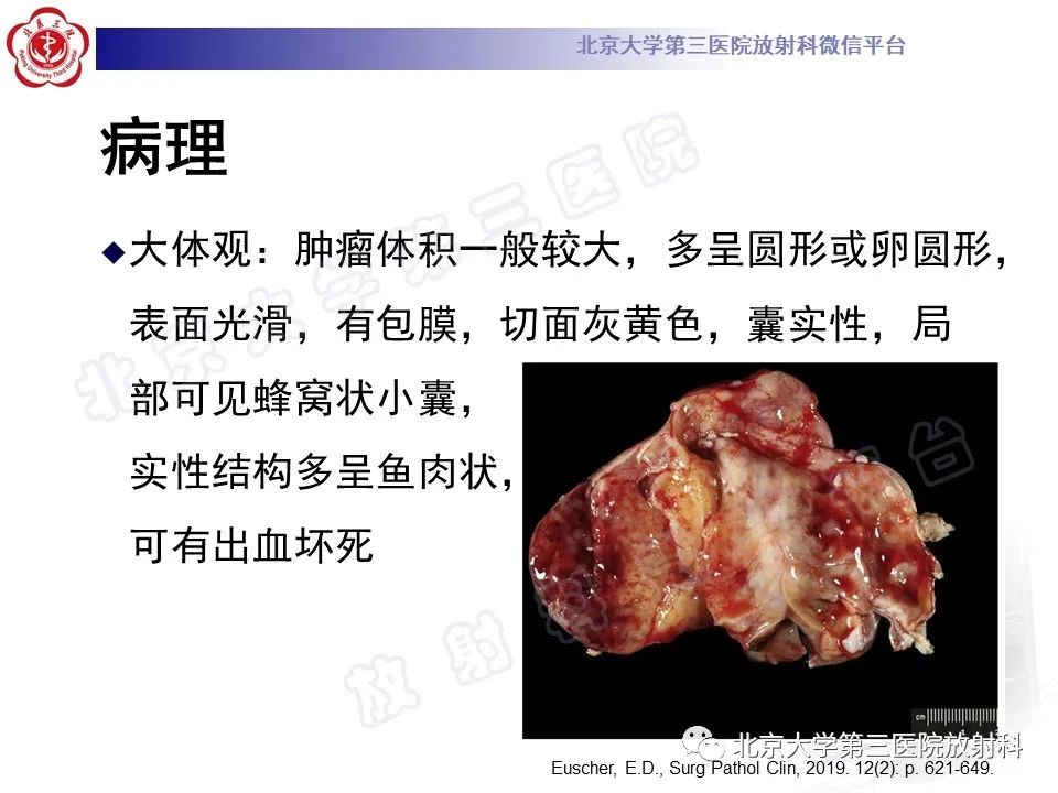 【PPT】卵巢卵黄囊瘤/内胚窦瘤-11