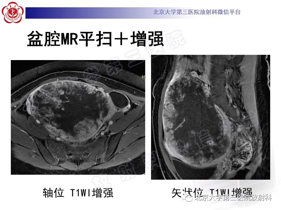 【PPT】卵巢卵黄囊瘤/内胚窦瘤-6