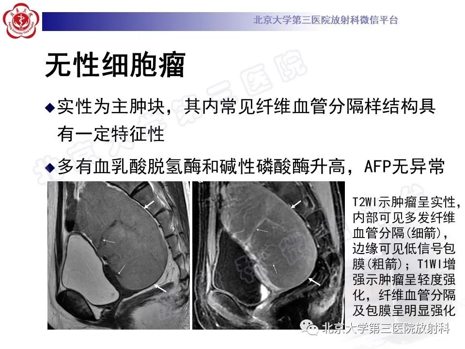 【PPT】卵巢卵黄囊瘤/内胚窦瘤-19
