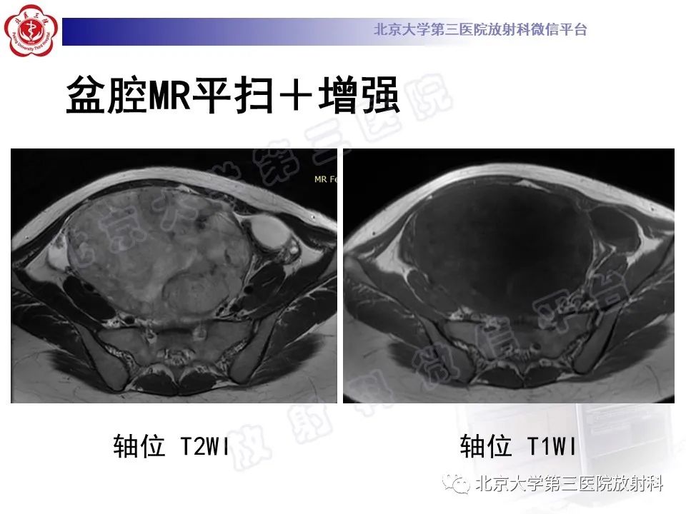 【PPT】卵巢卵黄囊瘤/内胚窦瘤-3