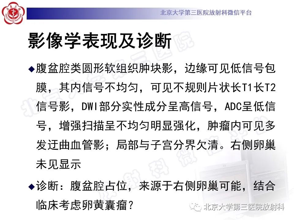 【PPT】卵巢卵黄囊瘤/内胚窦瘤-7