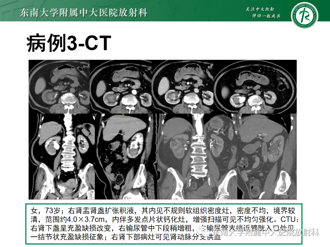 【PPT】肾盂癌-21