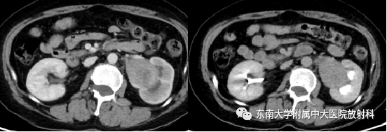 【PPT】肾盂癌-2
