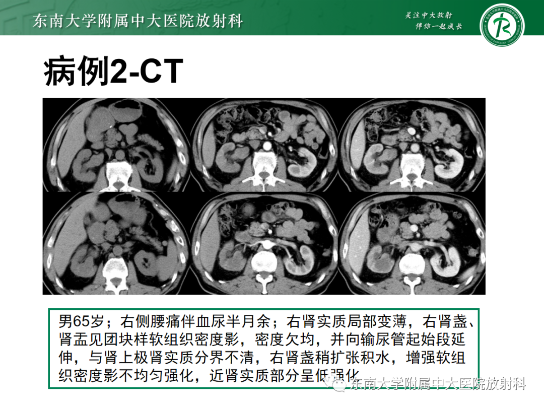 【PPT】肾盂癌-14