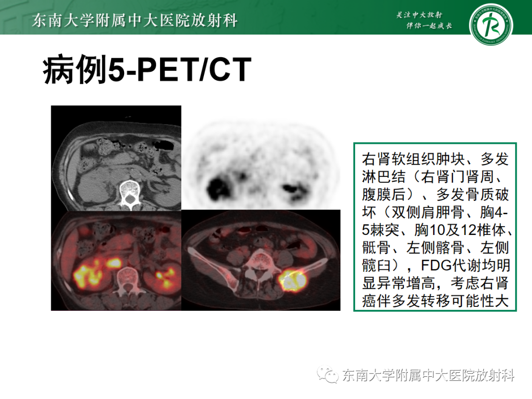 【PPT】肾盂癌-33