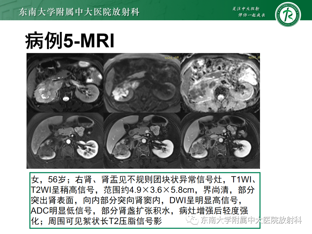 【PPT】肾盂癌-32