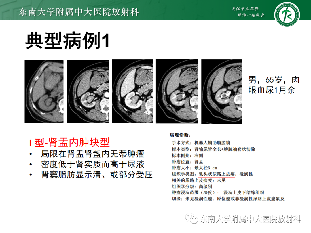 【PPT】肾盂癌-10