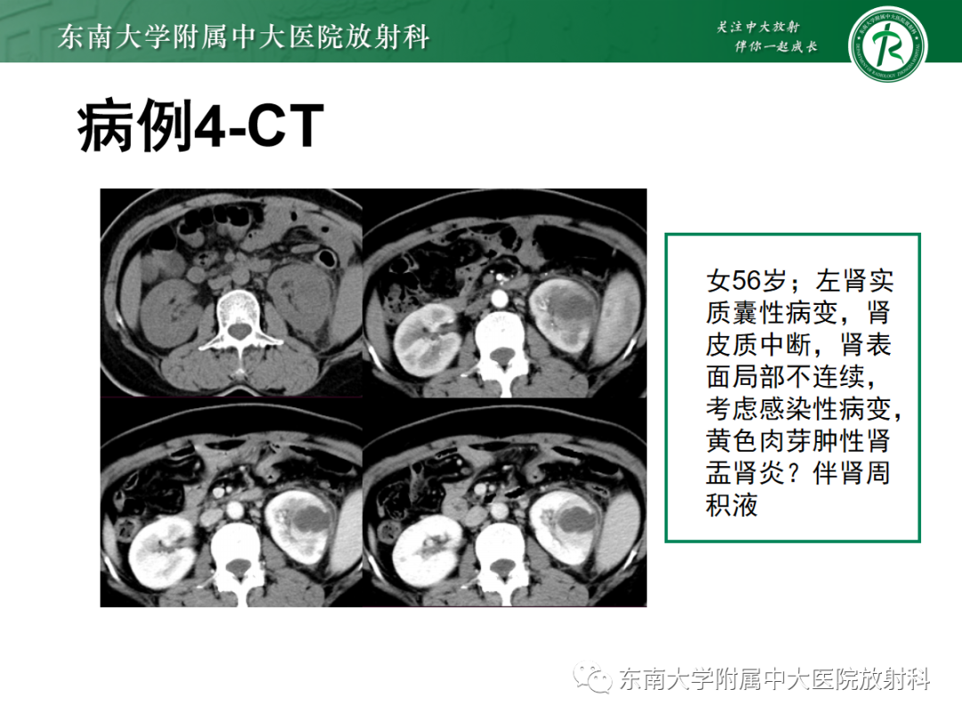 【PPT】肾盂癌-27