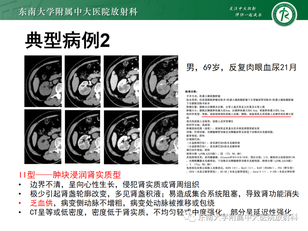 【PPT】肾盂癌-11