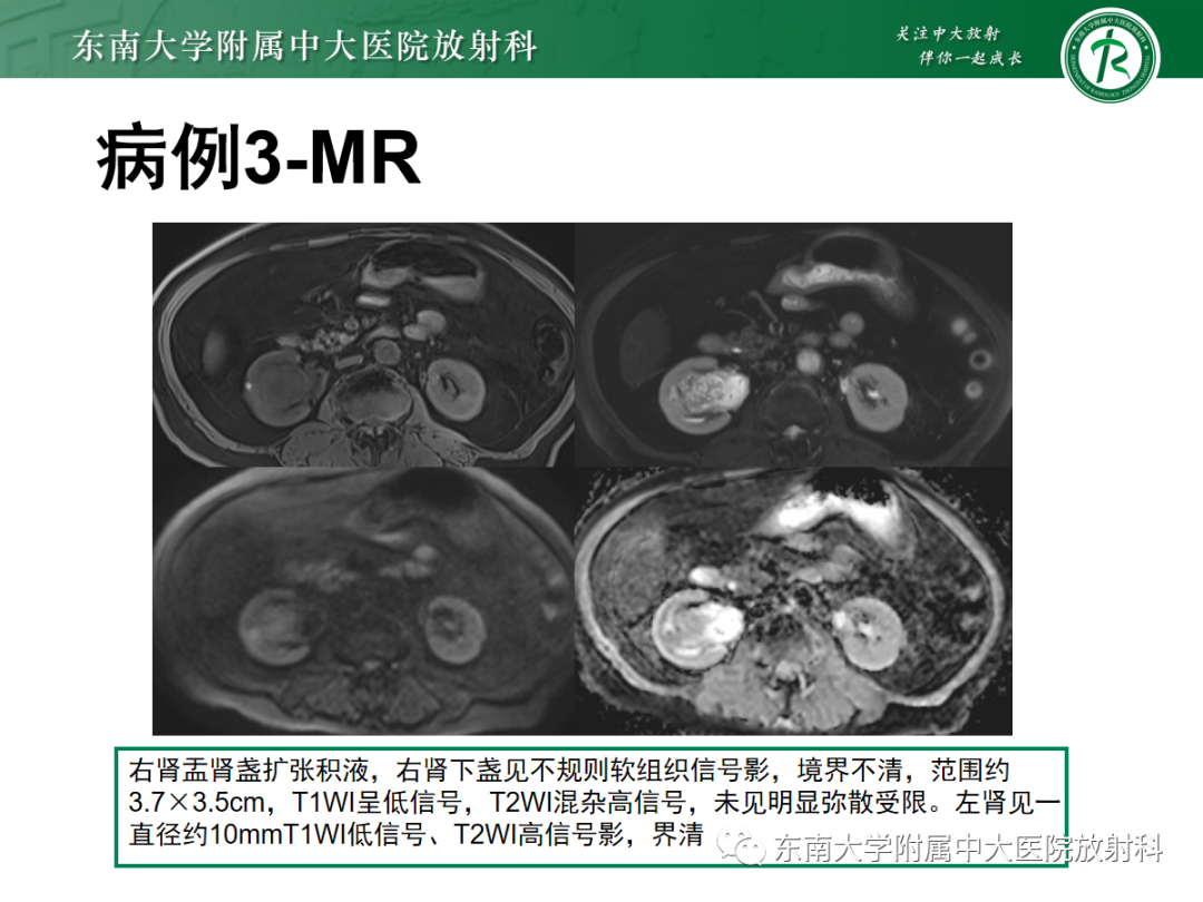 【PPT】肾盂癌-22