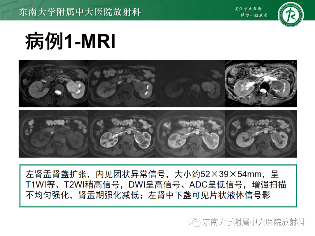 【PPT】肾盂癌-4