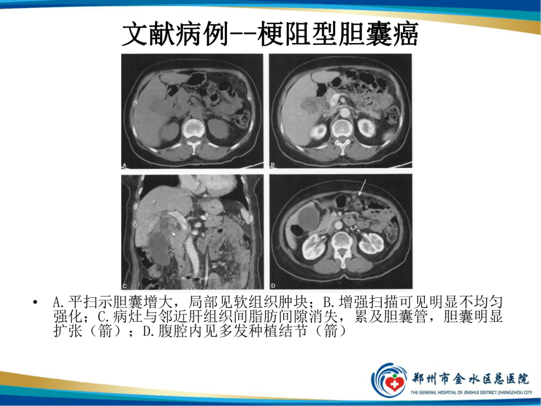 【PPT】胆囊癌的影像诊断-13