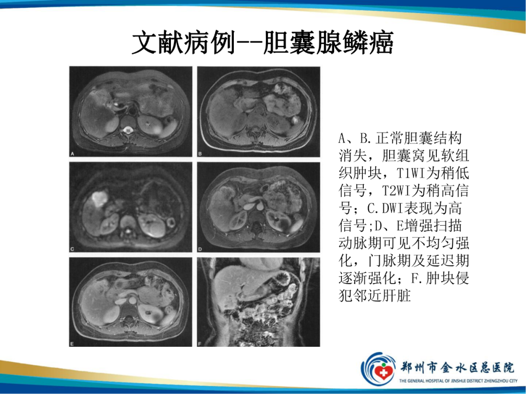 【PPT】胆囊癌的影像诊断-15