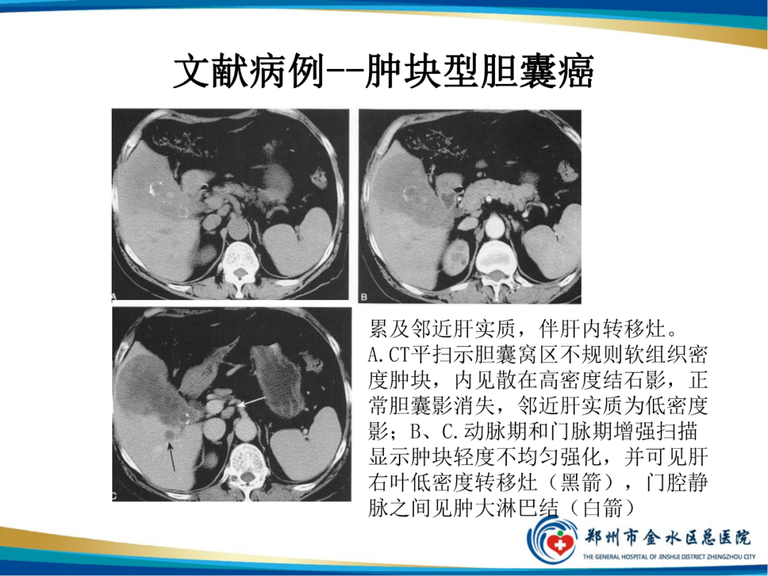 【PPT】胆囊癌的影像诊断-12