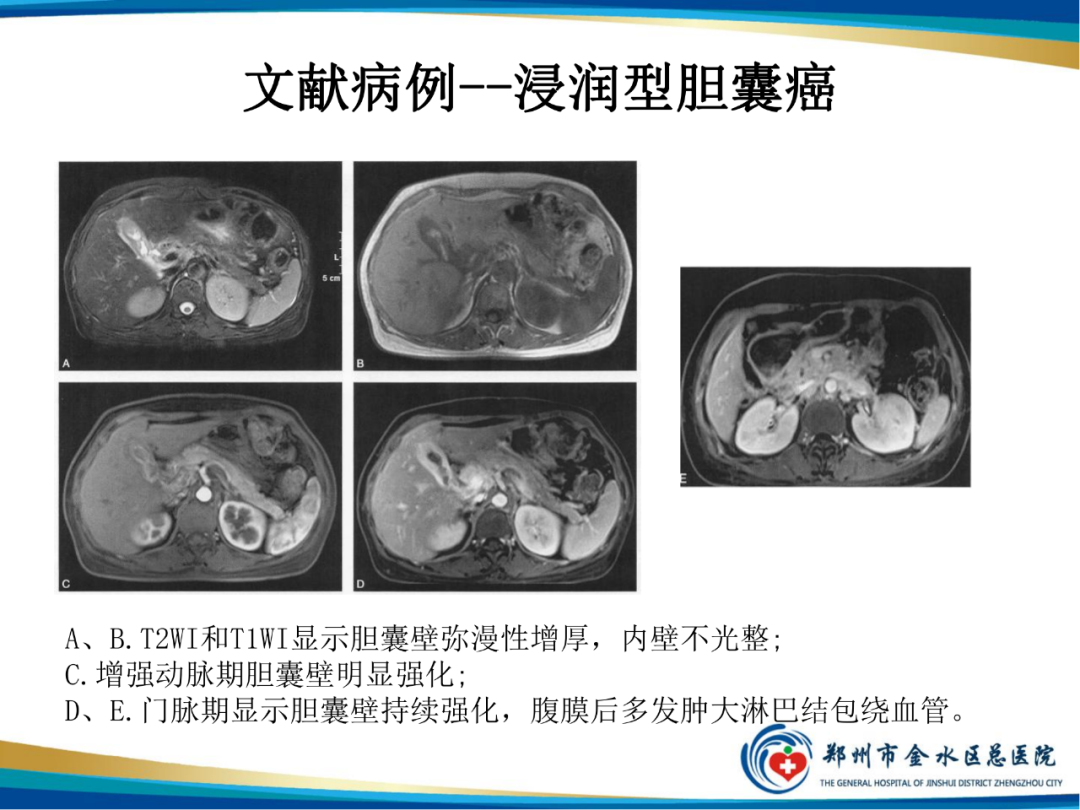 【PPT】胆囊癌的影像诊断-10