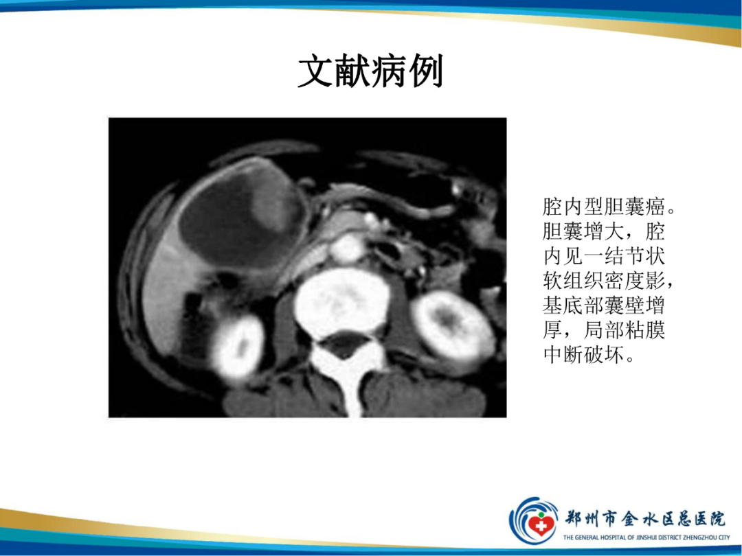 【PPT】胆囊癌的影像诊断-17