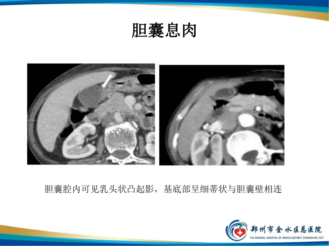 【PPT】胆囊癌的影像诊断-27