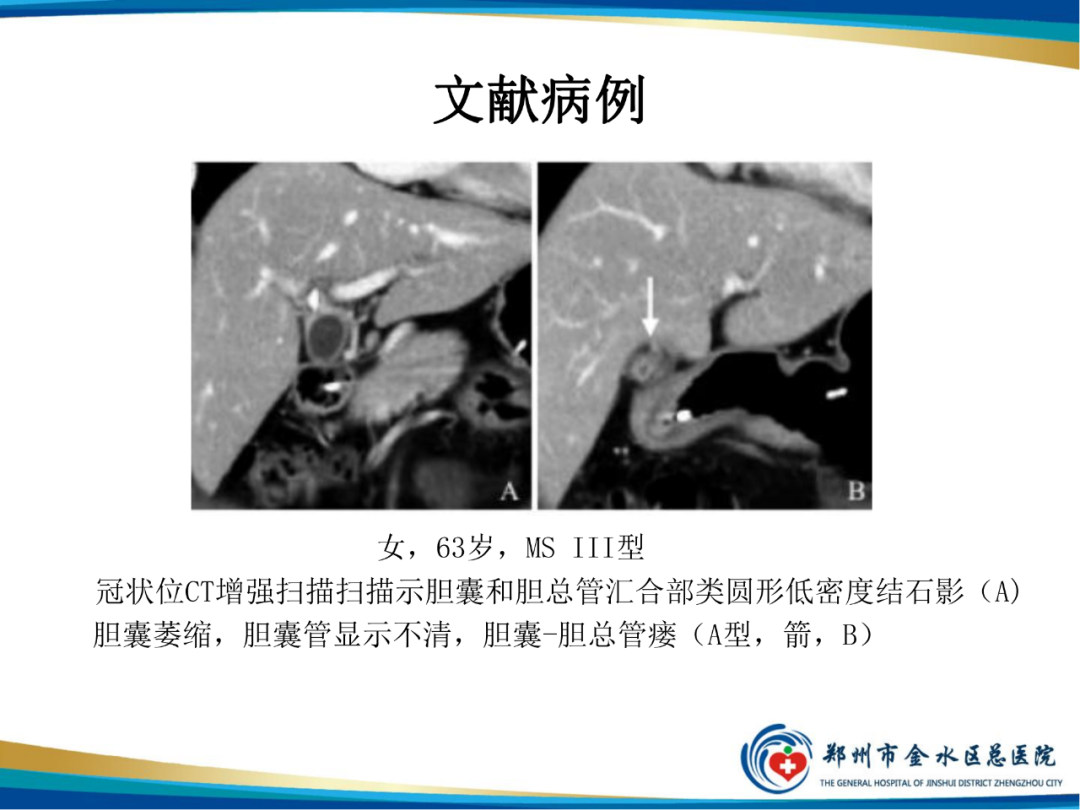 【PPT】胆囊癌的影像诊断-32