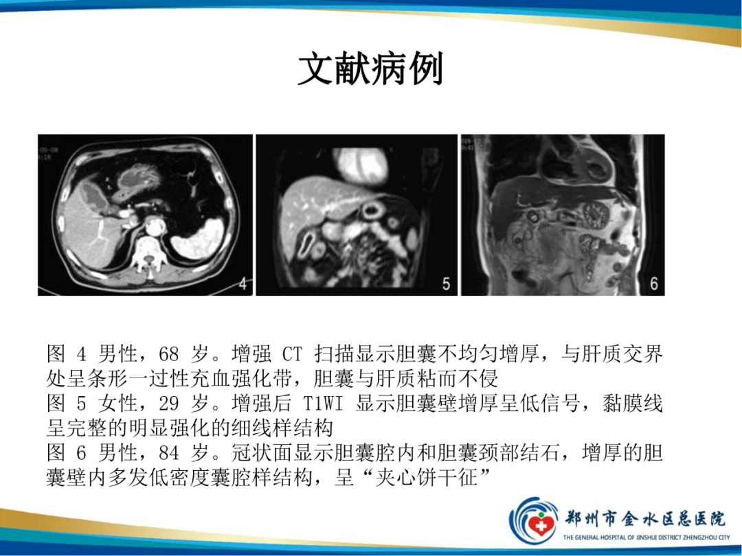 【PPT】胆囊癌的影像诊断-20